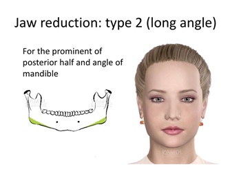 resezione ad angolo lungo, per la metà posteriore prominente degli angoli mandibolari