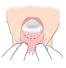 incisione all'interno della bocca