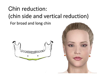 Riduzione del mento nella zona del mento mediante resezione e accorciamento di un mento