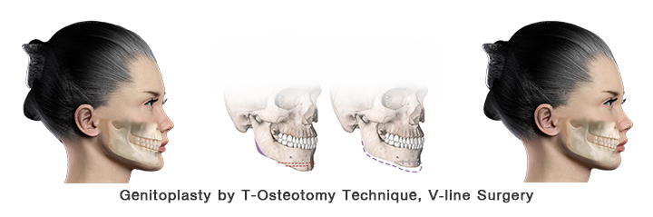 Riduzione del mento mediante T-Osteotomia, chirurgia V-Line