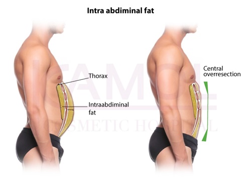 the_area_of_excess_fat_above_and_below_the_abdominal_cavity_and_six-pack_creation.
