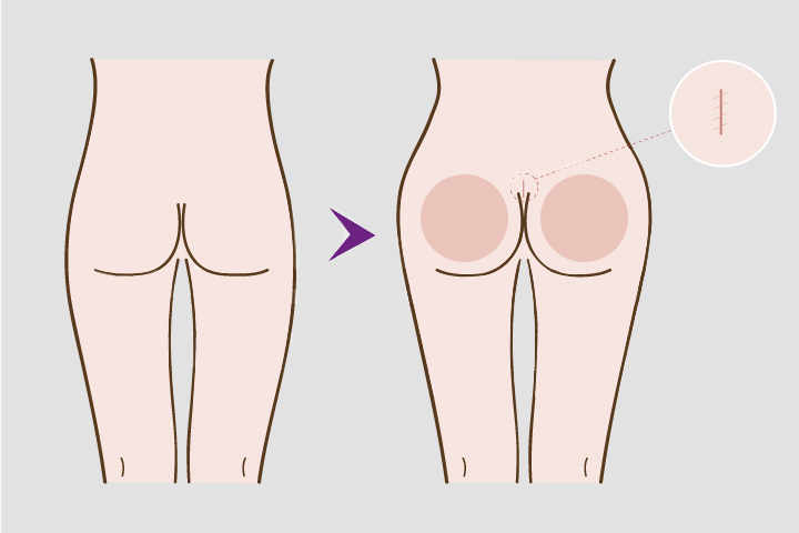 buttock_surgery_by_Buttock_Implants
