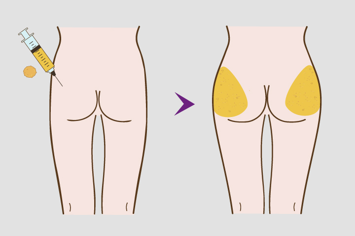 Plastic Surgery Case Study - Buttock Implants in Asian Gluteal