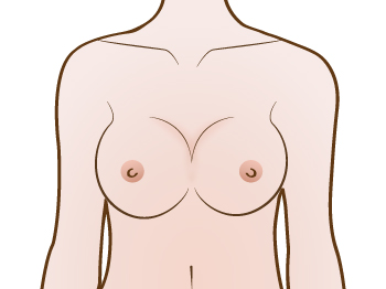 Symmastia or  Uniboob correction