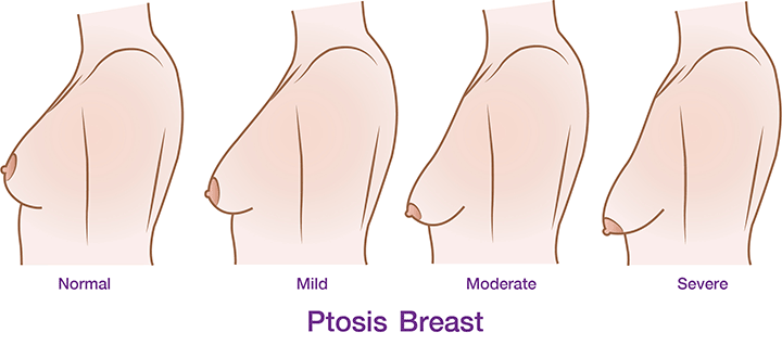 FREE BOOBS! Independência do Sutiã é a tendência na cirurgia de prótese  mamária