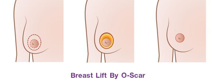 The incision around areolar ( O- Scar)