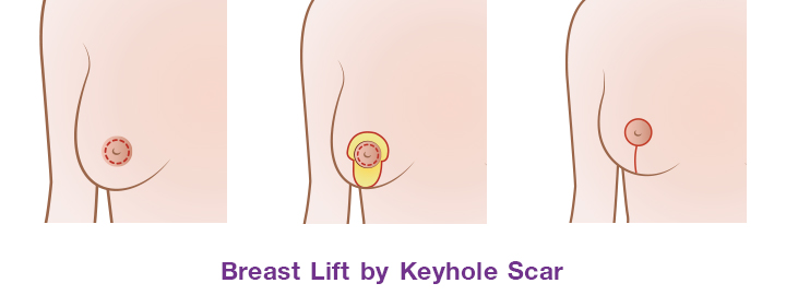 The incision around areolar and vertical down from the areolar to the breast crease (Keyhole- Scar )