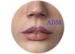 Cupid Bow Lip