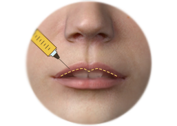 Lips Enhancement by Fat Graft