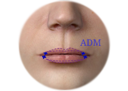 Lips Enhancement by the Acellular dermal matrix