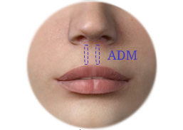 Phitrum enhancement with augmentation