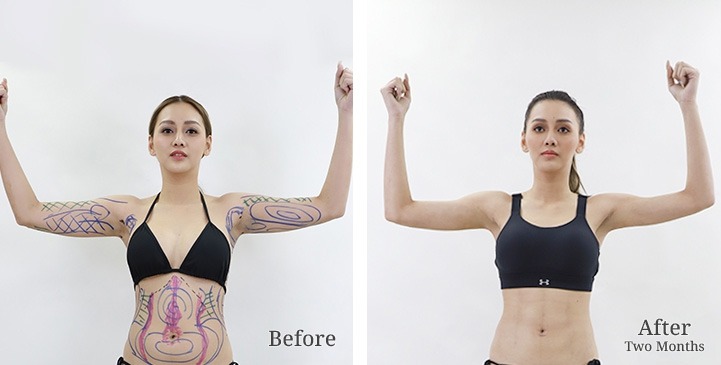 Upper Arm Lift Surgery / Brachioplasty in Bangkok, Thailand 2 WhatsApp Image 2026 10 06 at 11.22.24 (2)