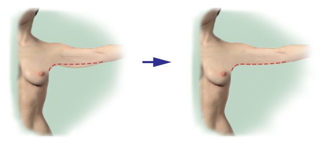 Upper arm lift incision line and resulting scar.