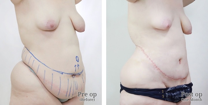 Body Contouring / Lipectomy in Bangkok, Thailand 4 WhatsApp Image 2026 10 05 at 13.56.39 (5)