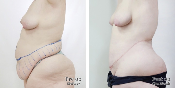 Body Contouring / Lipectomy in Bangkok, Thailand 5 WhatsApp Image 2026 10 05 at 13.56.39 (7)