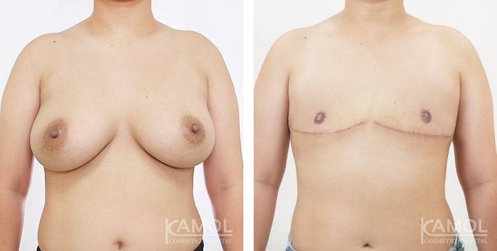 Mastectomy (Top Surgery) 84 6271