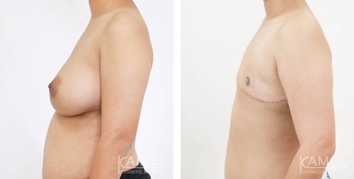 Mastectomy (Top Surgery) 85 6272