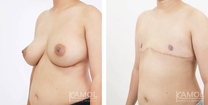 Mastectomy (Top Surgery) 86 6273