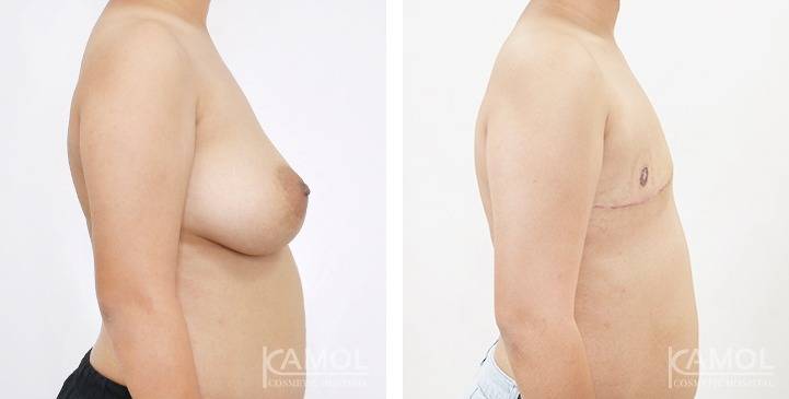 Mastectomy (Top Surgery) 87 6274