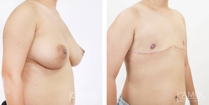 Mastectomy (Top Surgery) 88 6275