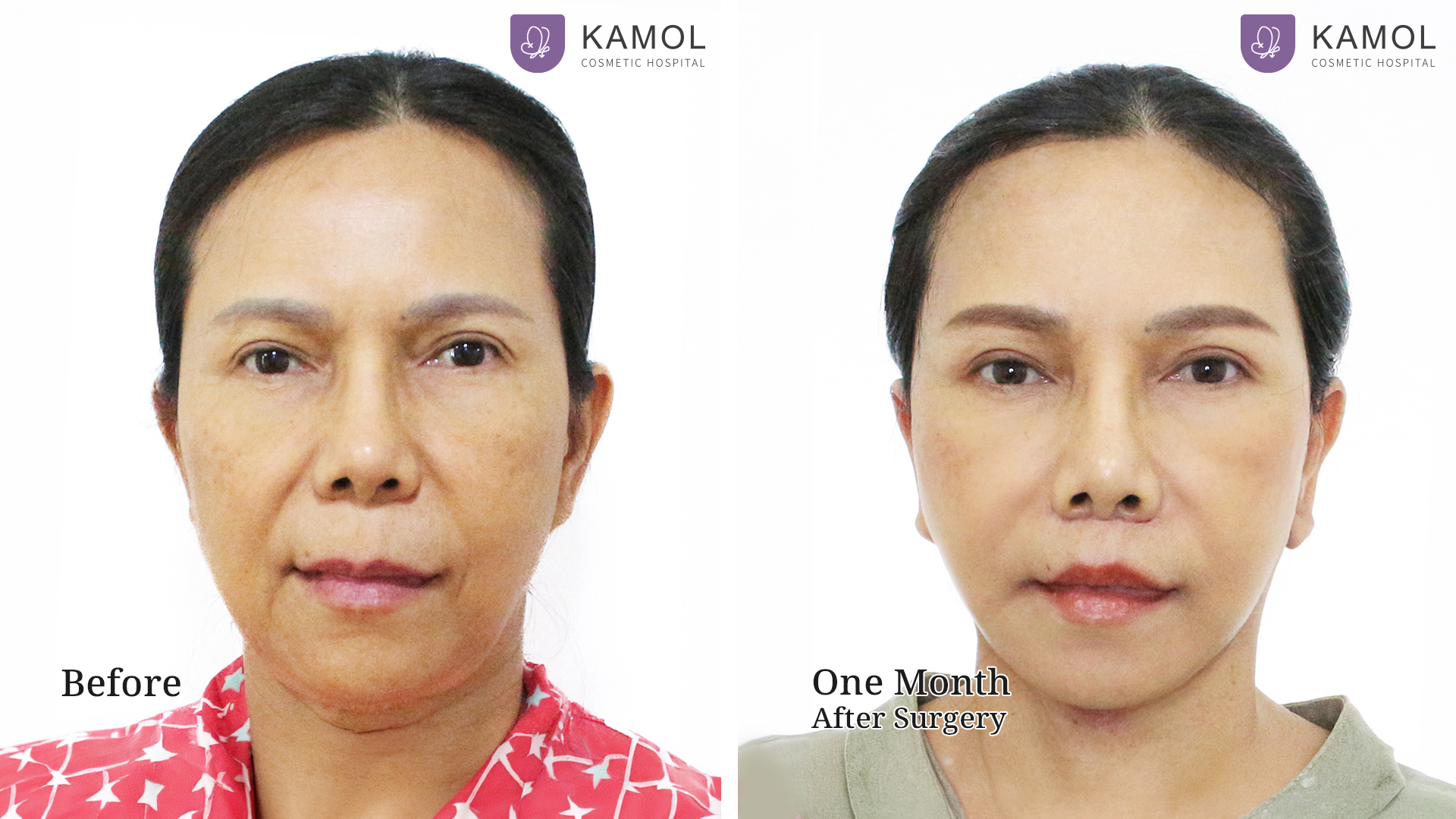 Facelift / Neck Lift Surgery in Bangkok, Thailand 7 Before After Facelift01 01 คริศชาญาญ์