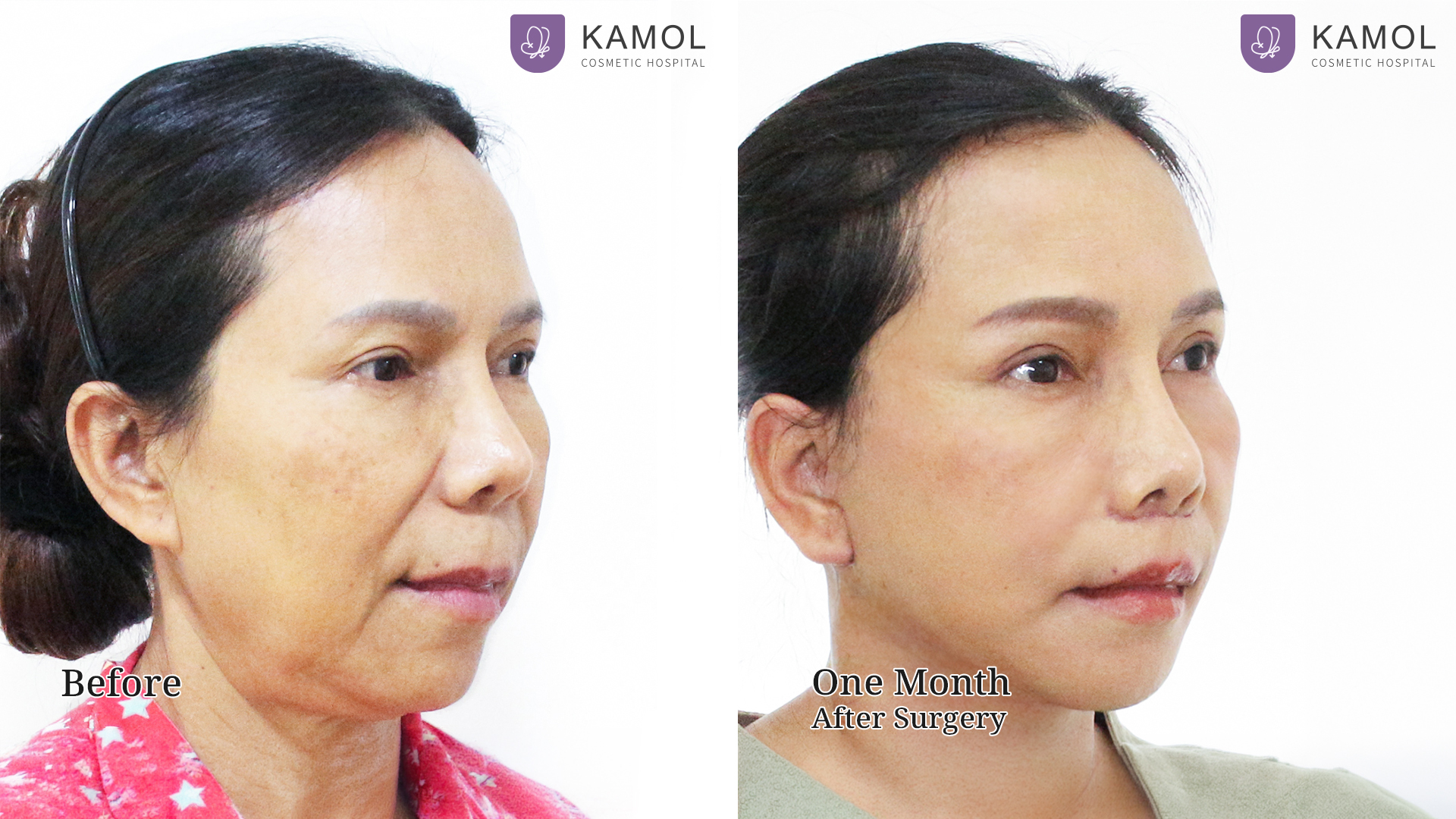 Facelift / Neck Lift Surgery in Bangkok, Thailand 8 Before After Facelift01 02 คริศชาญาญ์