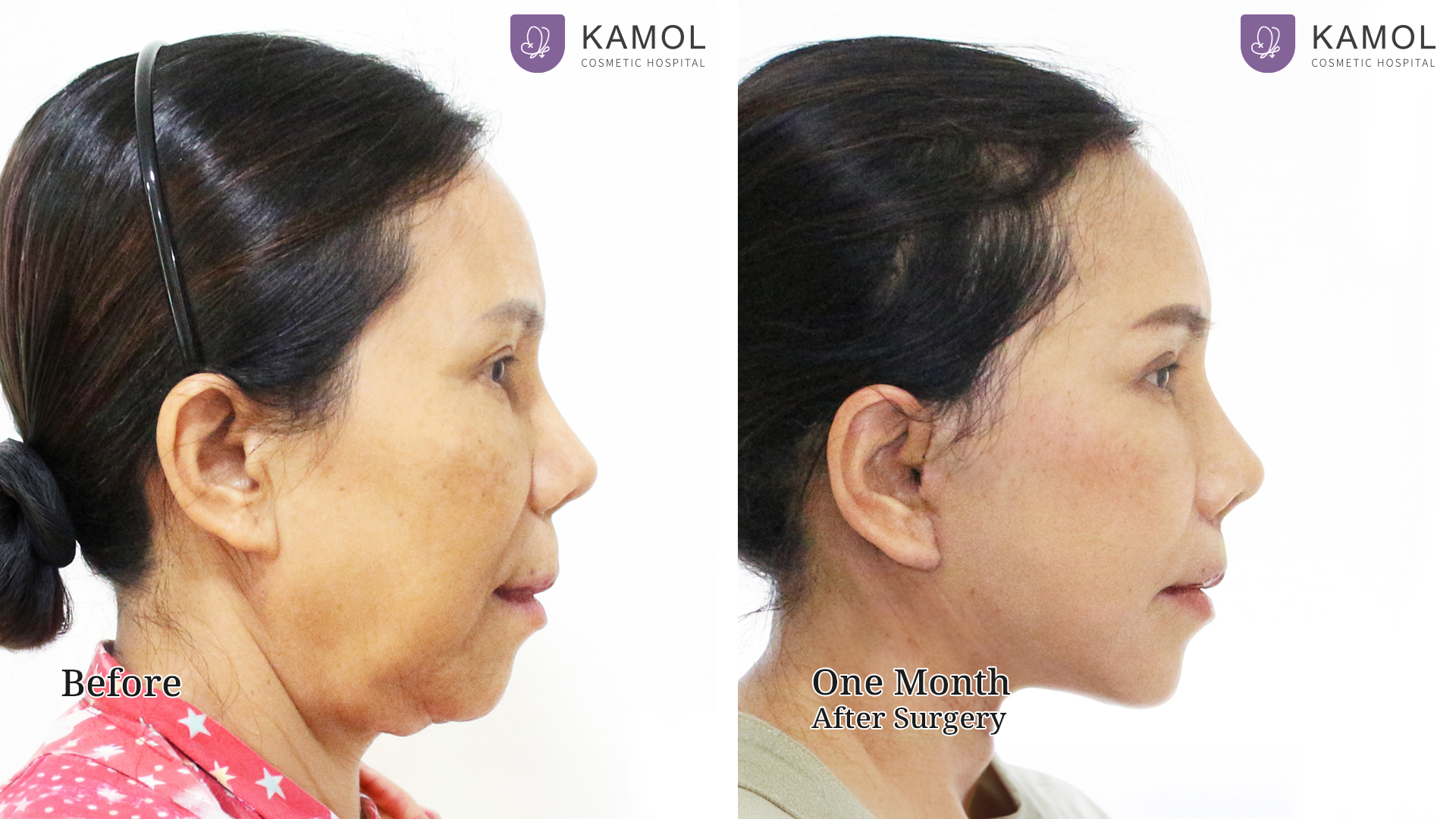 Facelift / Neck Lift Surgery in Bangkok, Thailand 9 Before After Facelift01 03 คริศชาญาญ์