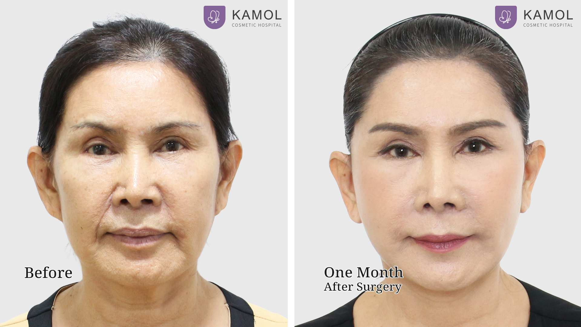 Face Lift 41 Facelift with Endotine