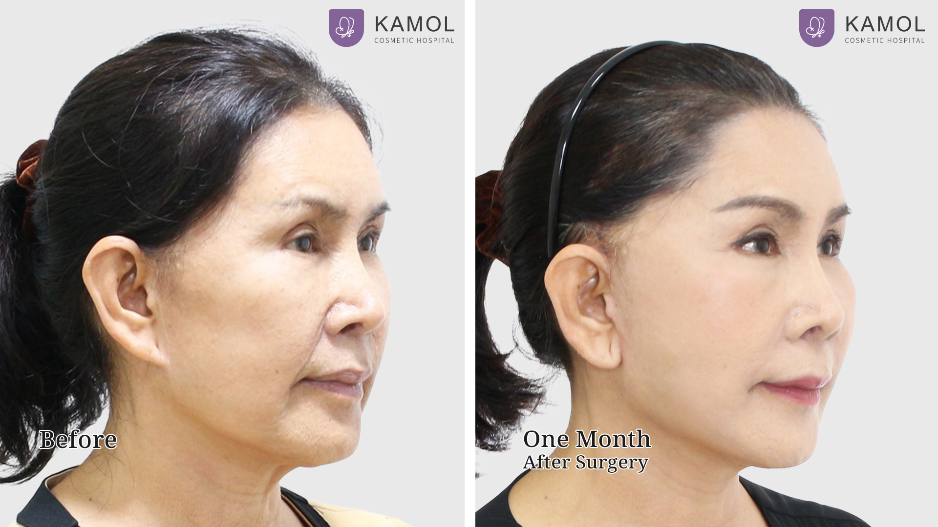 Face Lift 42 Facelift with Endotine