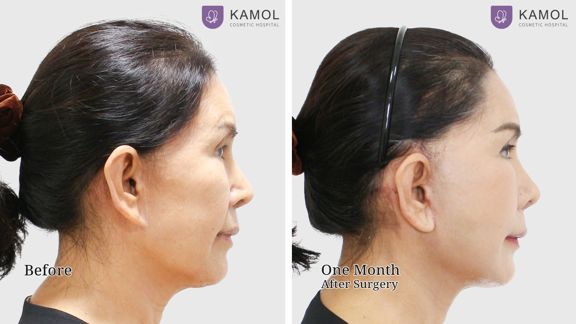 Face Lift 43 Facelift with Endotine