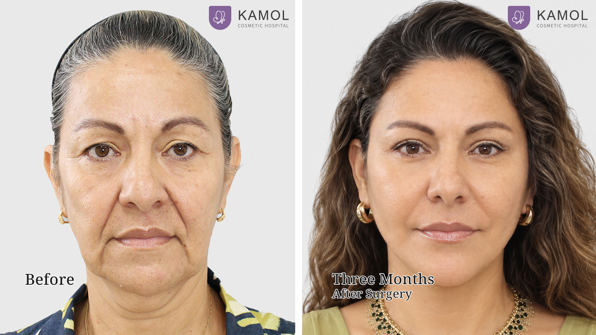 Face Lift 30 Facelift with Deep Plane Technique