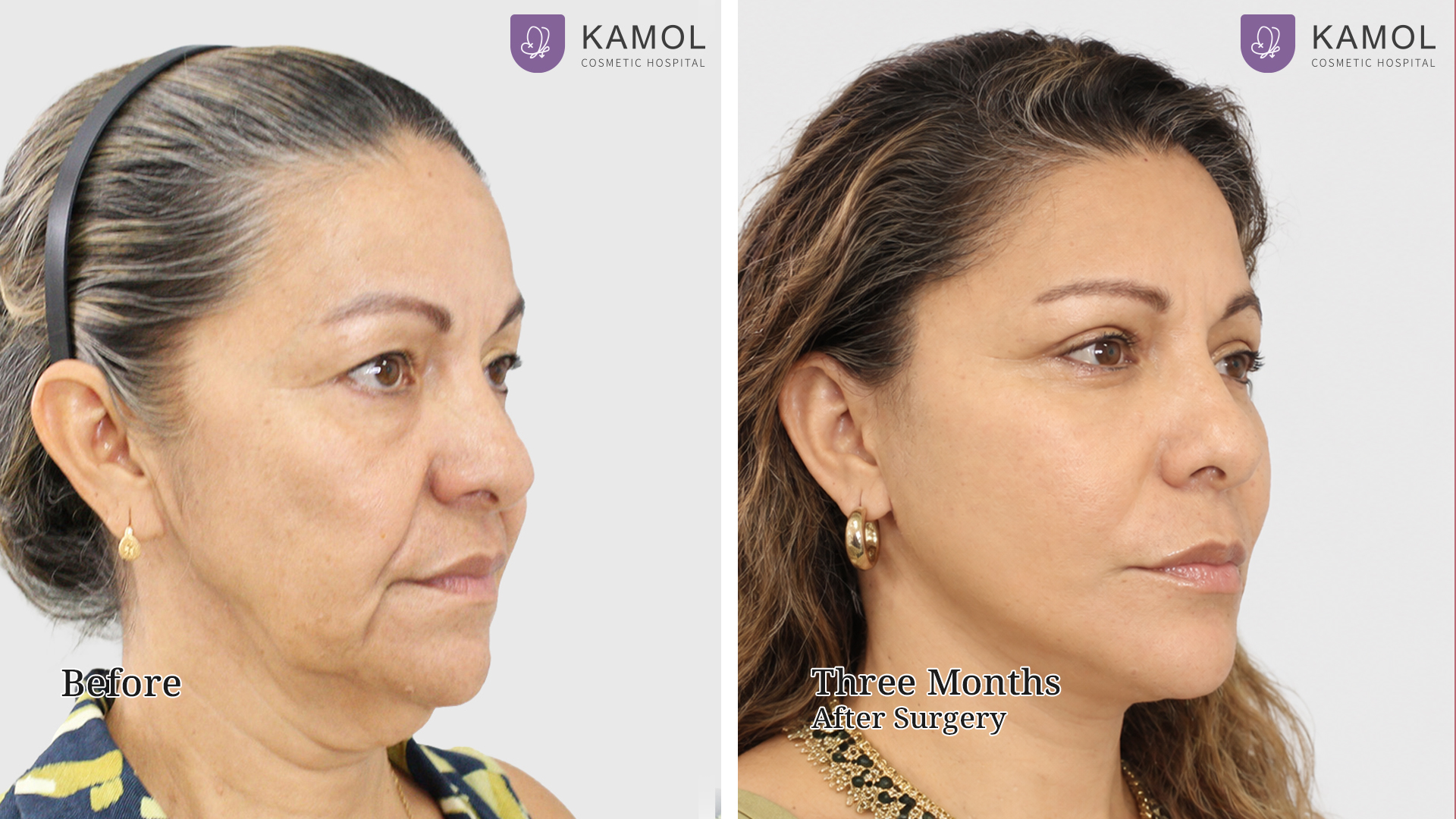 Face Lift 31 Facelift Cristina Ardila02