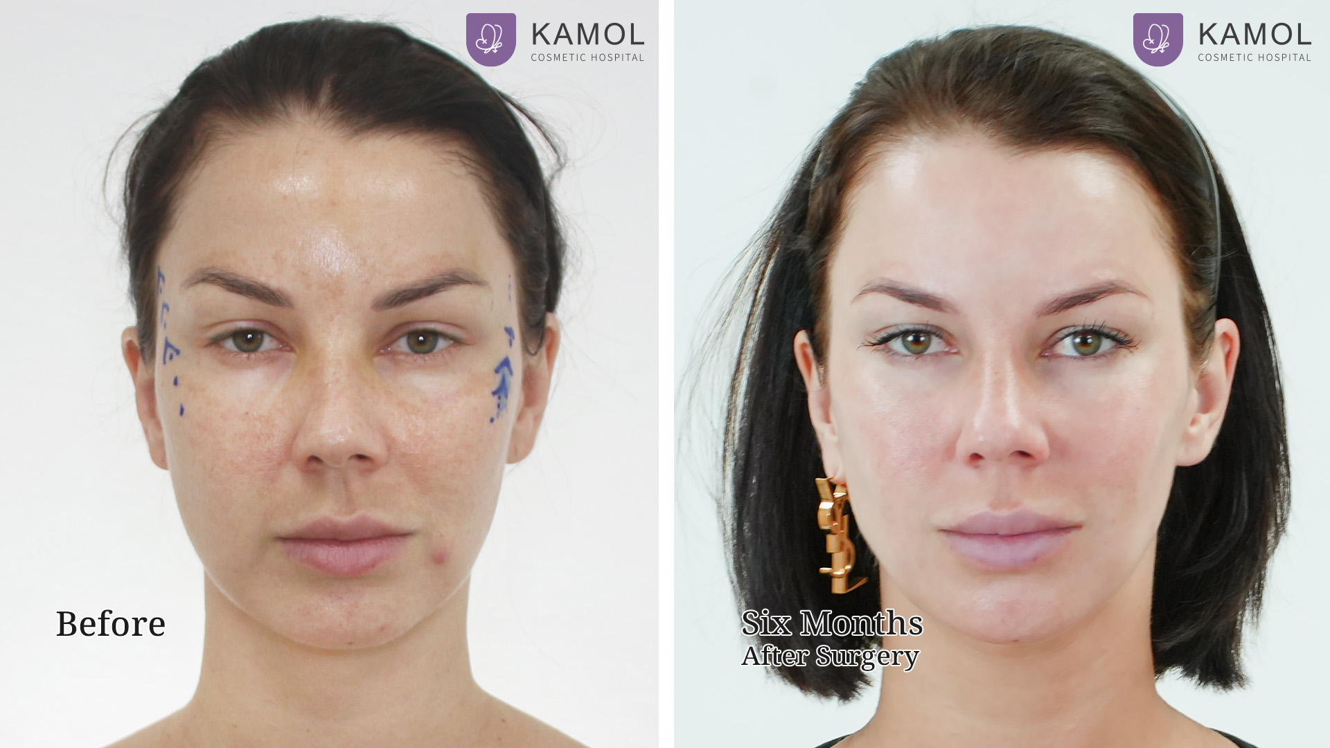 Face Lift 37 Mid Facelift with Endotine