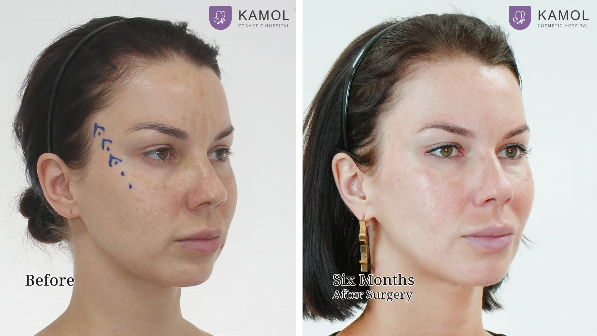 Face Lift 38 Mid Facelift with Endotine