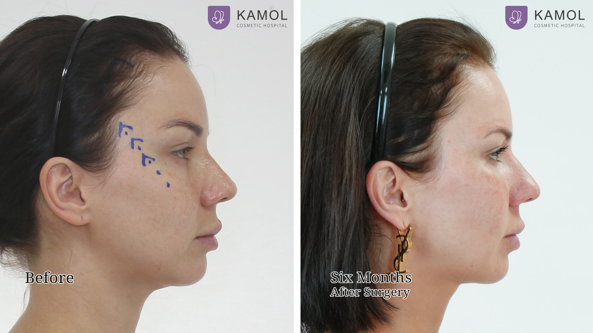Face Lift 39 Mid Facelift with Endotine