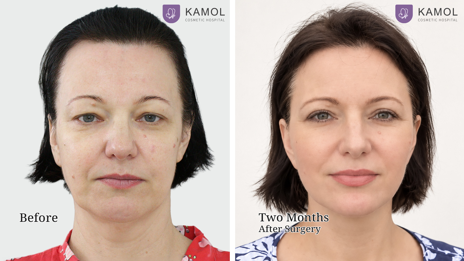 Facelift / Neck Lift Surgery in Bangkok, Thailand 10 Facelift Irina04