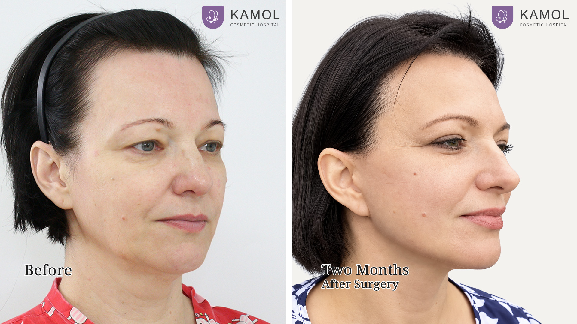 Facelift / Neck Lift Surgery in Bangkok, Thailand 11 Facelift Irina05