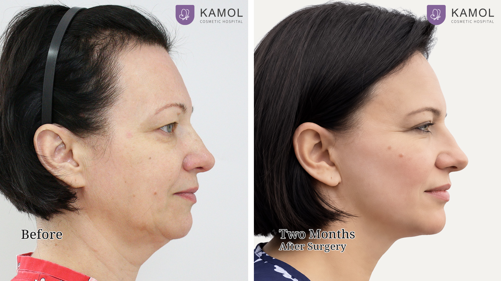 Facelift / Neck Lift Surgery in Bangkok, Thailand 12 Facelift Irina06