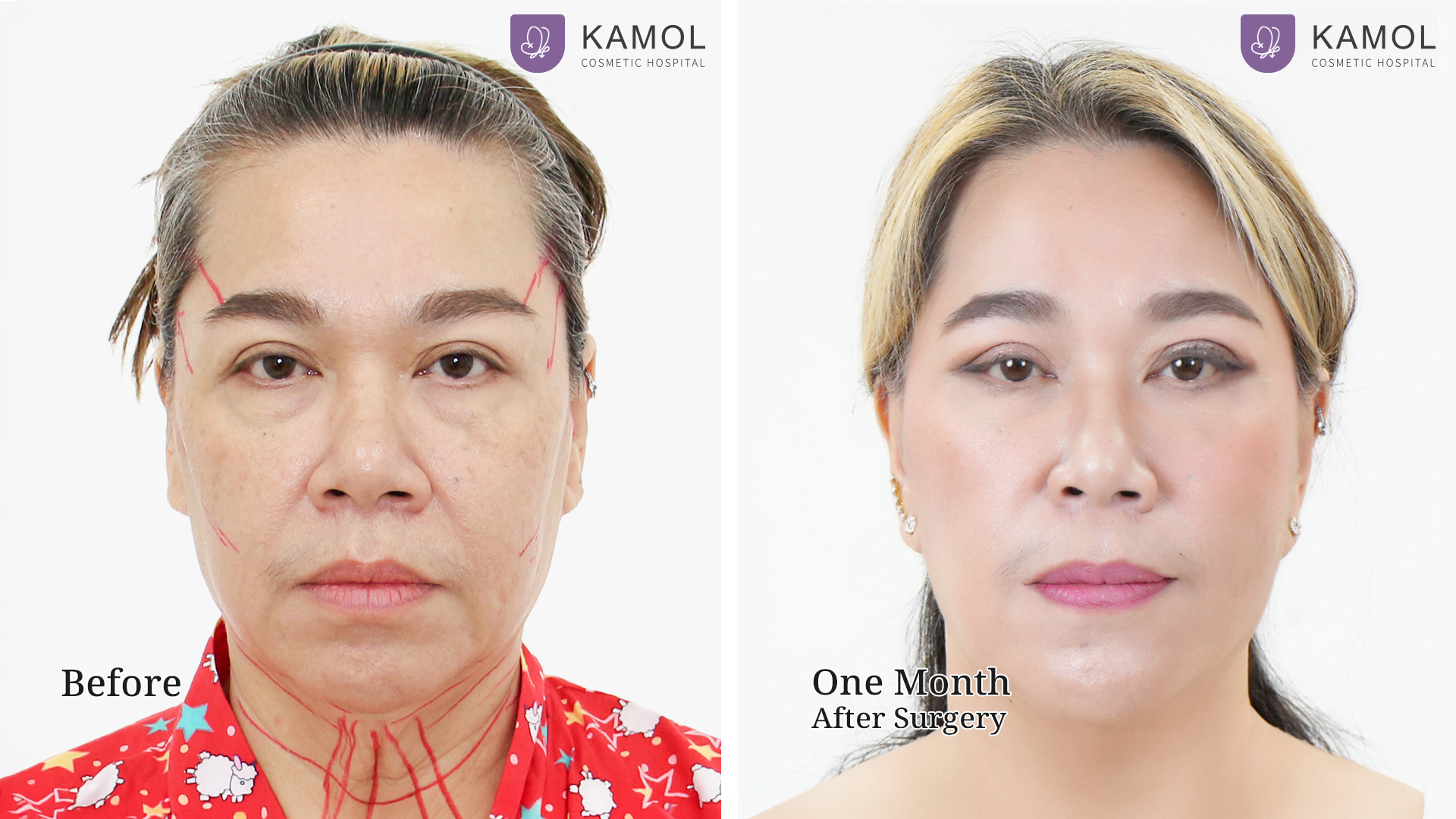 Face Lift 10 Facelift จิตรา01
