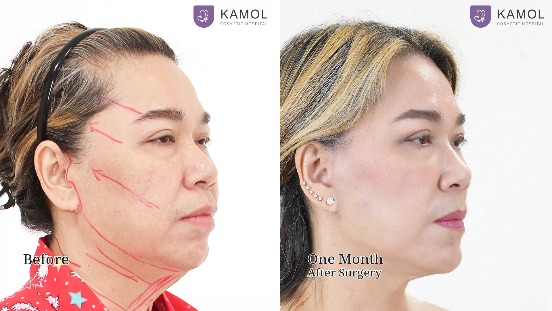 Face Lift 11 Facelift จิตรา02