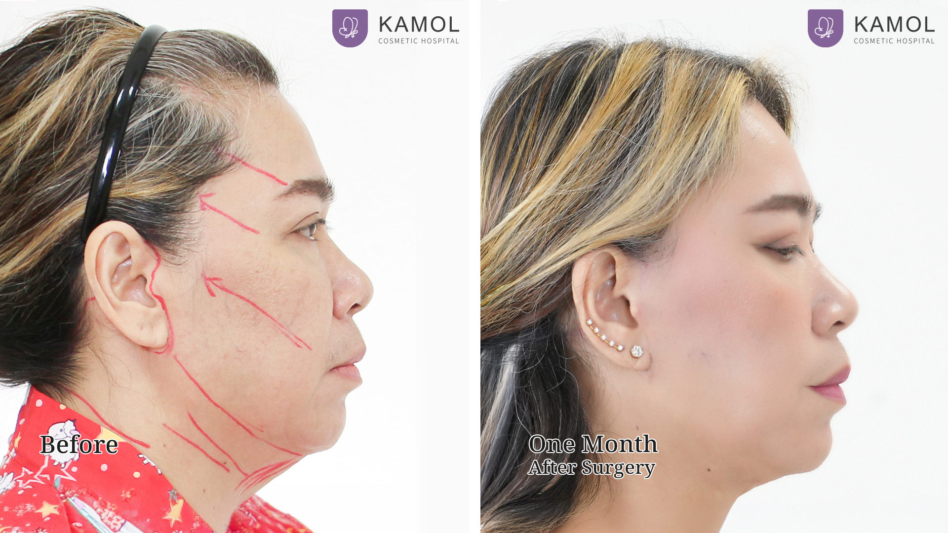 Face Lift 12 Facelift จิตรา03