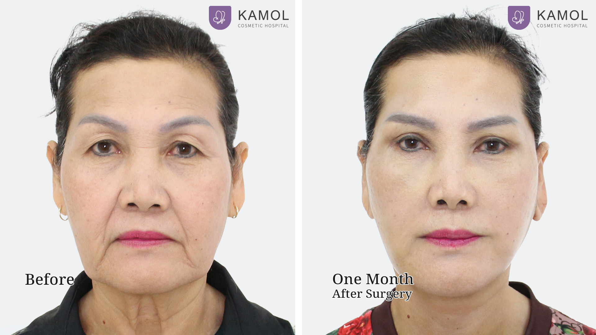Face Lift 22 Facelift จินตนา หนูววรณ01