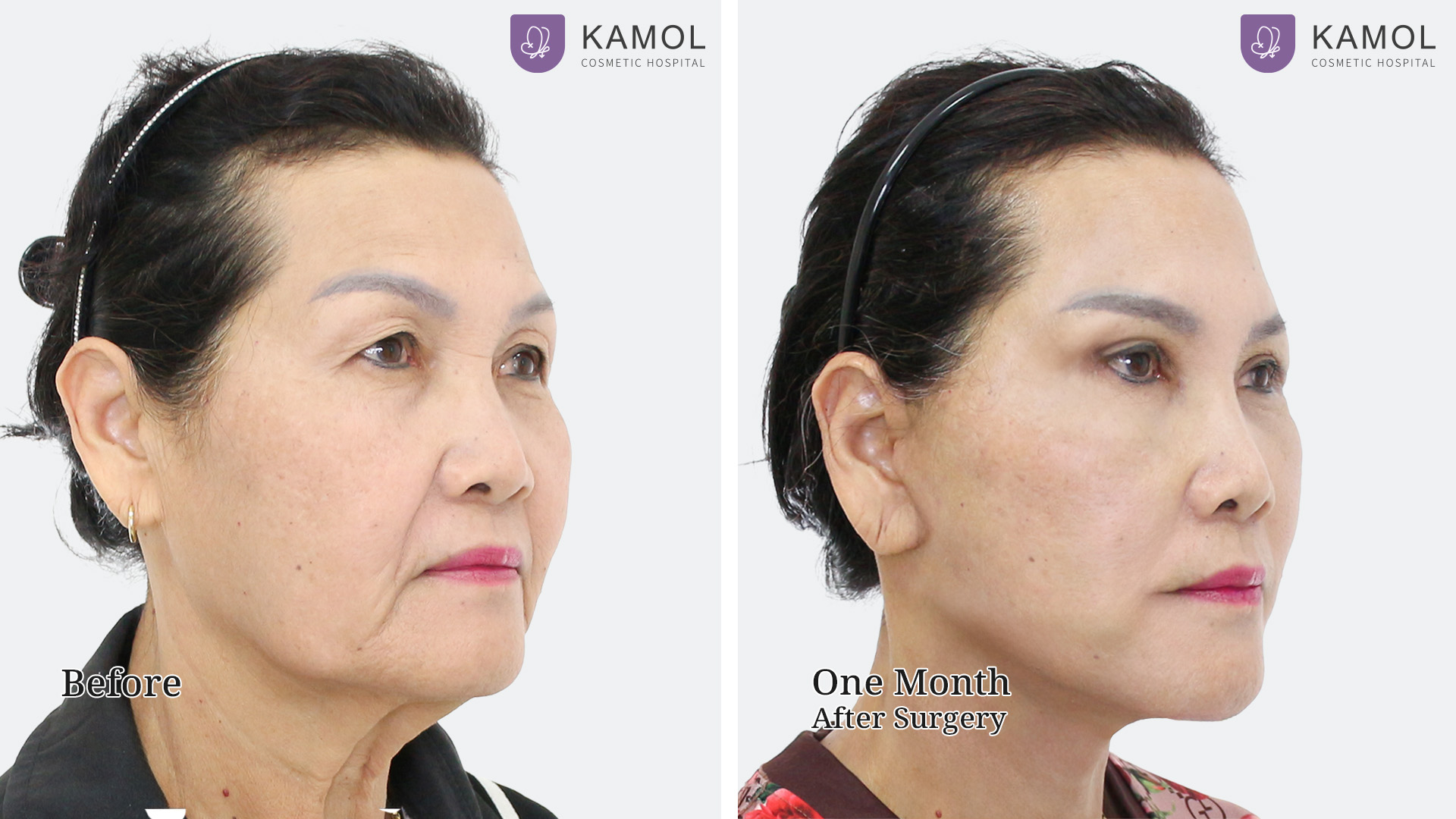 Face Lift 23 Facelift จินตนา หนูววรณ02