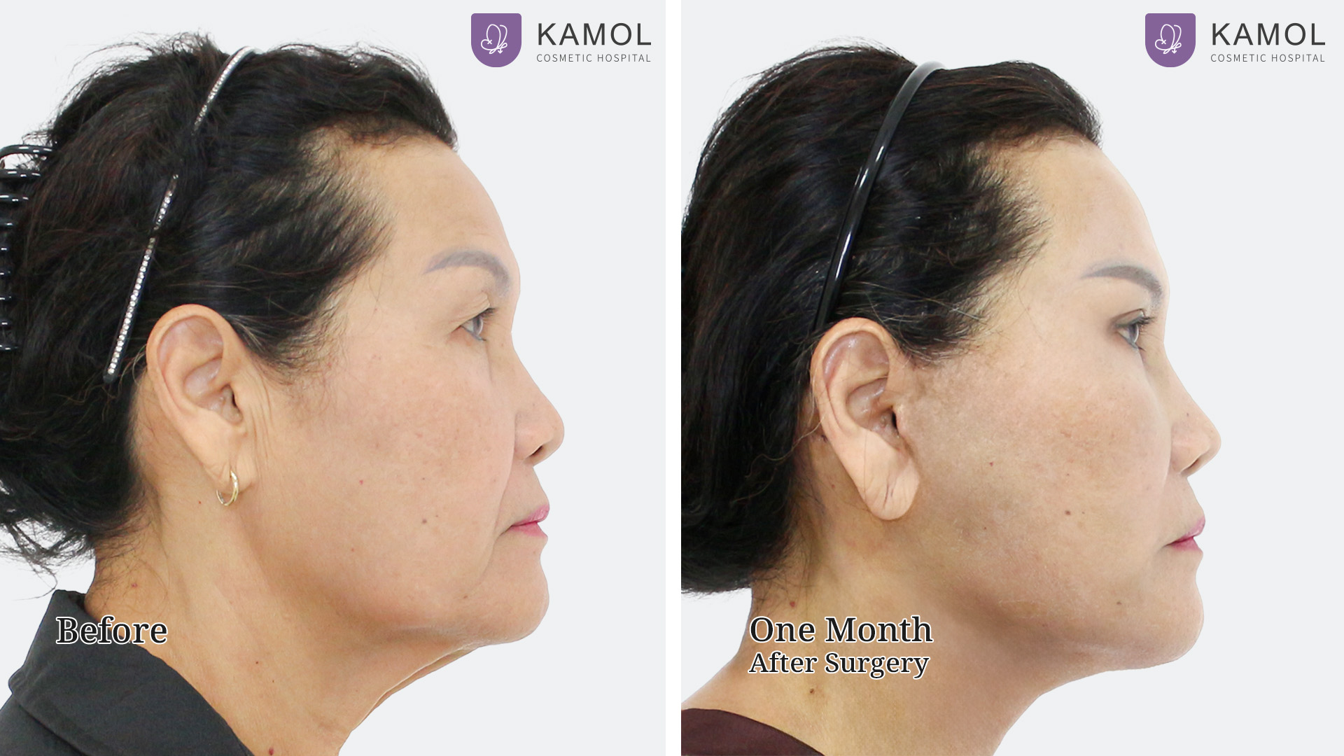 Face Lift 24 Facelift จินตนา หนูววรณ03
