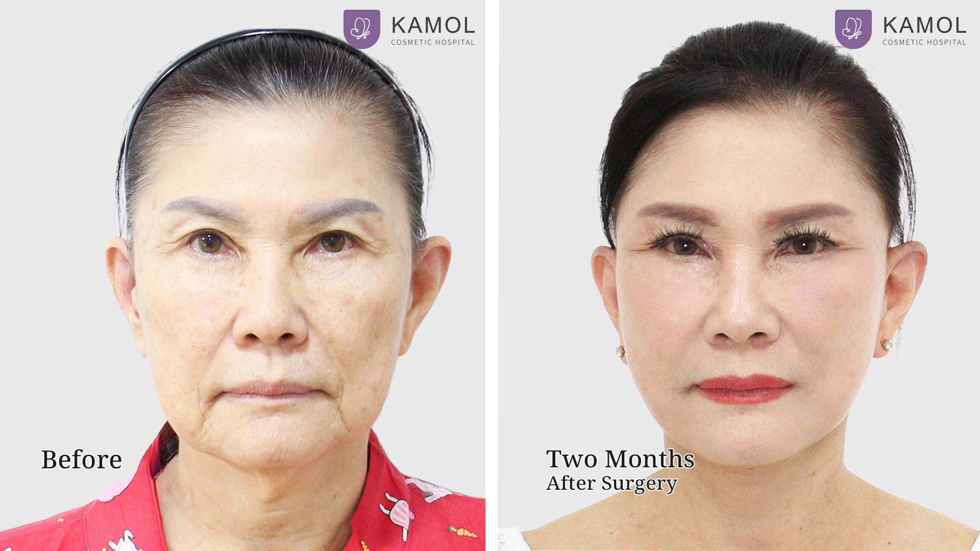 Face Lift 6 Facelift จินตนา01
