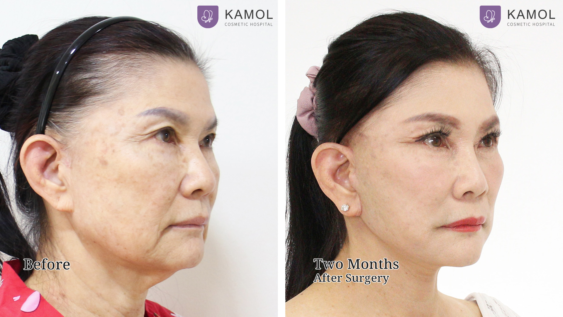 Face Lift 7 Facelift จินตนา02
