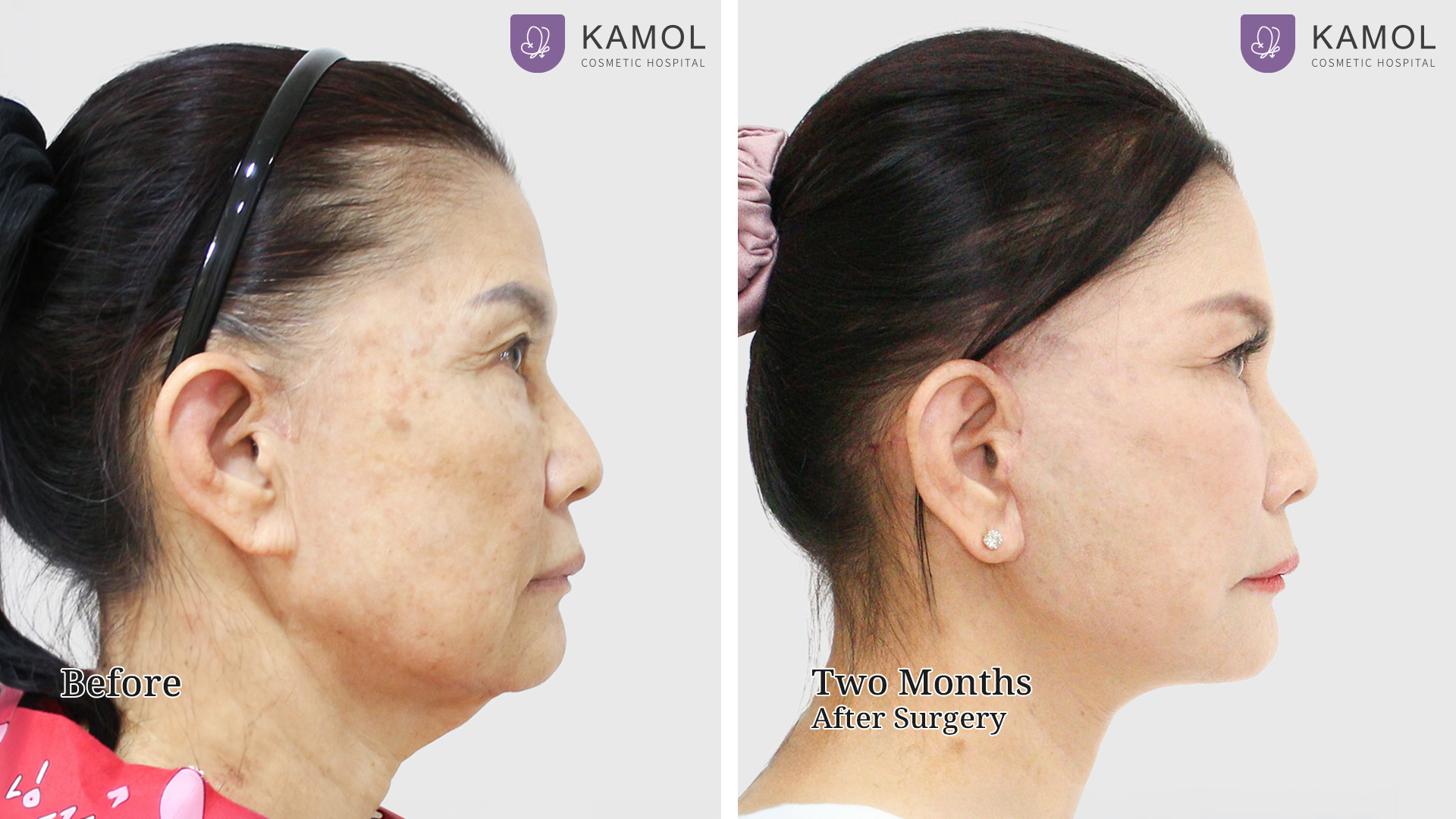 Face Lift 8 Facelift จินตนา03