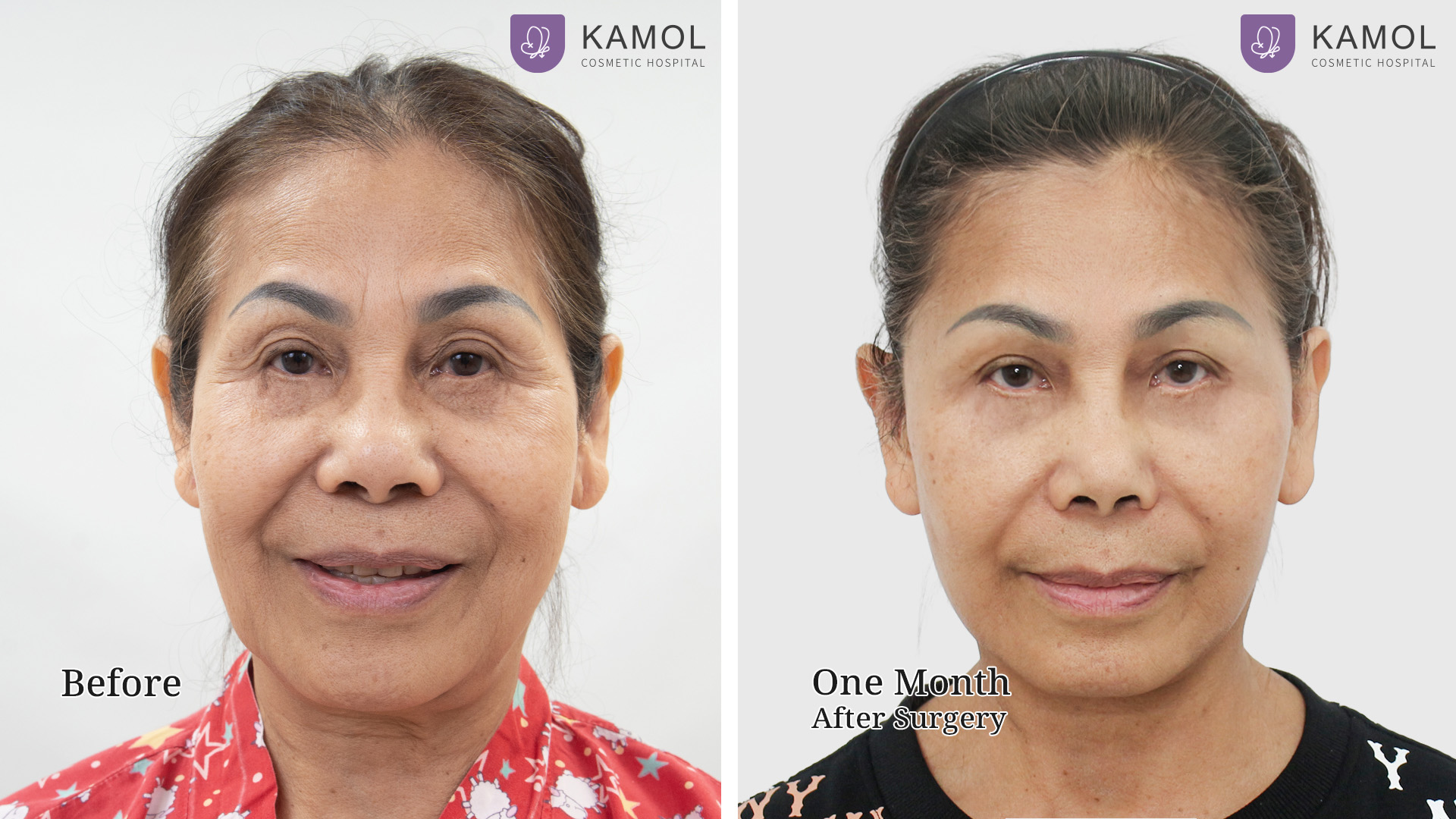 Face Lift 26 Facelift ฐิติพร01