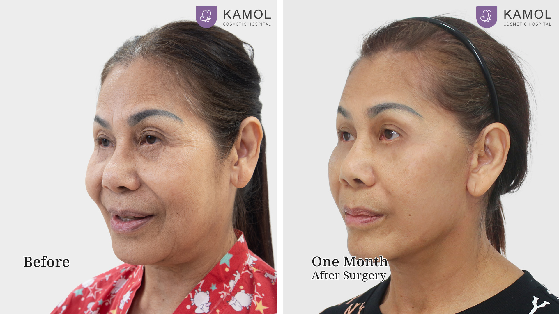 Face Lift 27 Facelift ฐิติพร02