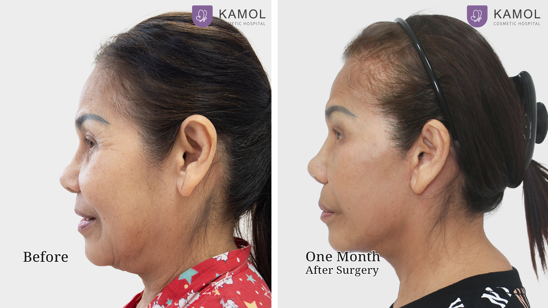 Face Lift 28 Facelift ฐิติพร03